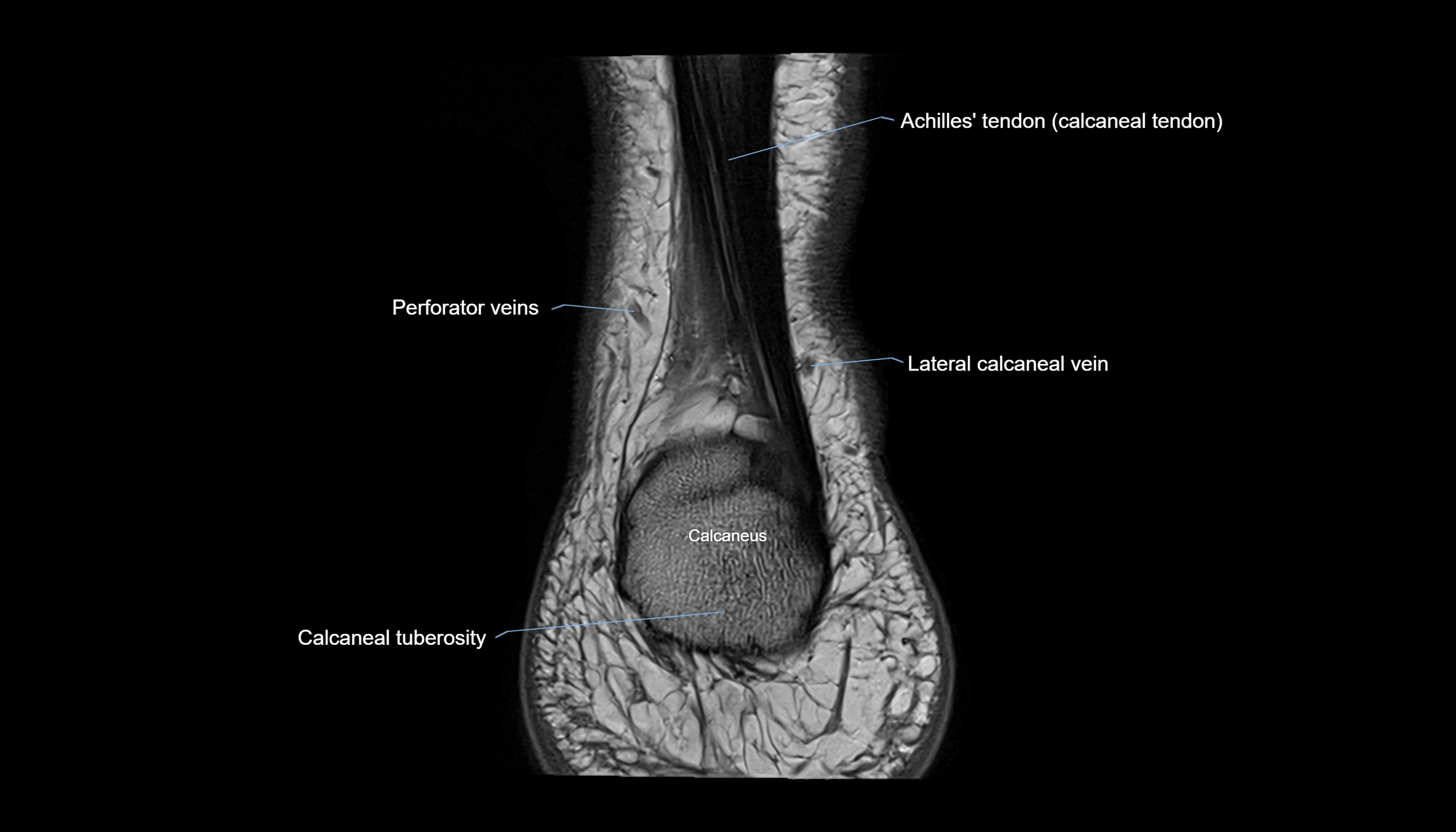 Ankle coronal anatomy 3T MRI images -img-11001-00030.webp